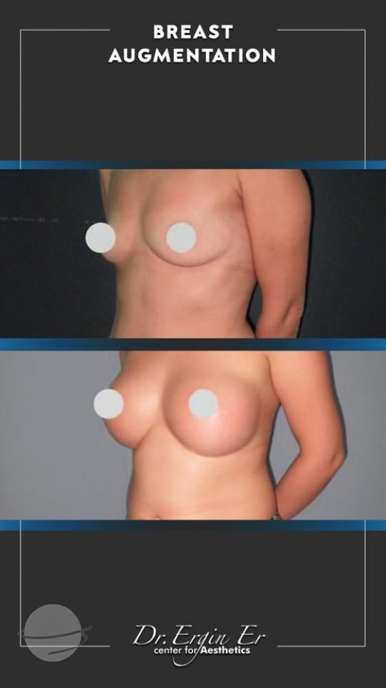 DR ERGIN ER ISTANBUL RESULTS SURGERY 17