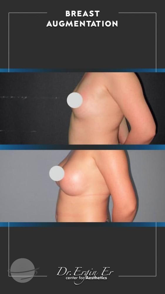 DR ERGIN ER ISTANBUL RESULTS SURGERY 22