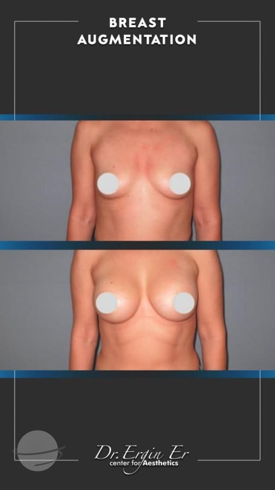 DR ERGIN ER ISTANBUL RESULTS SURGERY 19