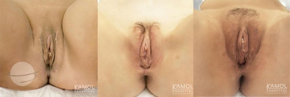 KAMOL HOSPITAL SRS MTF surgery results1