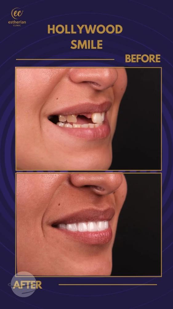 Cosmetic surgery Istanbul Before and after 6