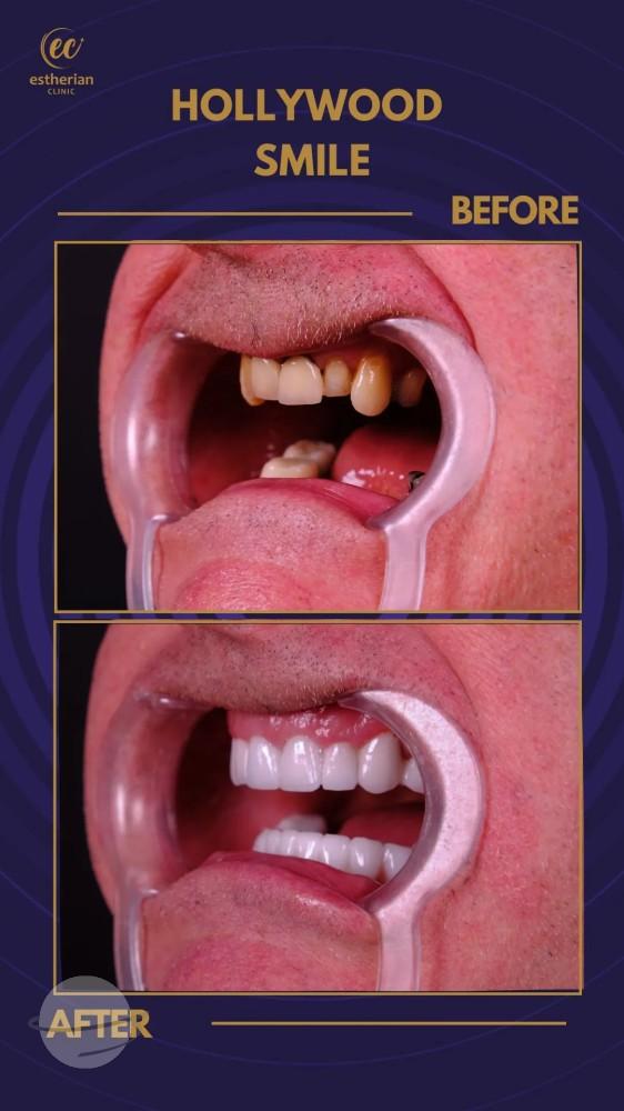 Cosmetic surgery Istanbul Before and after 7