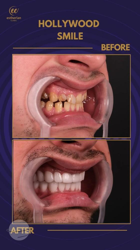 Cosmetic surgery Istanbul Before and after 8