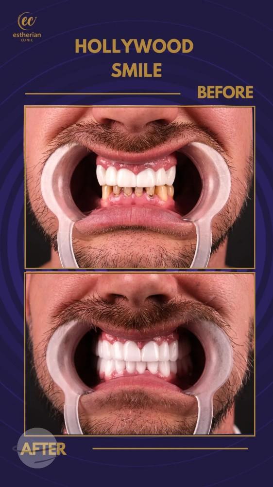 Cosmetic surgery Istanbul Before and after 10