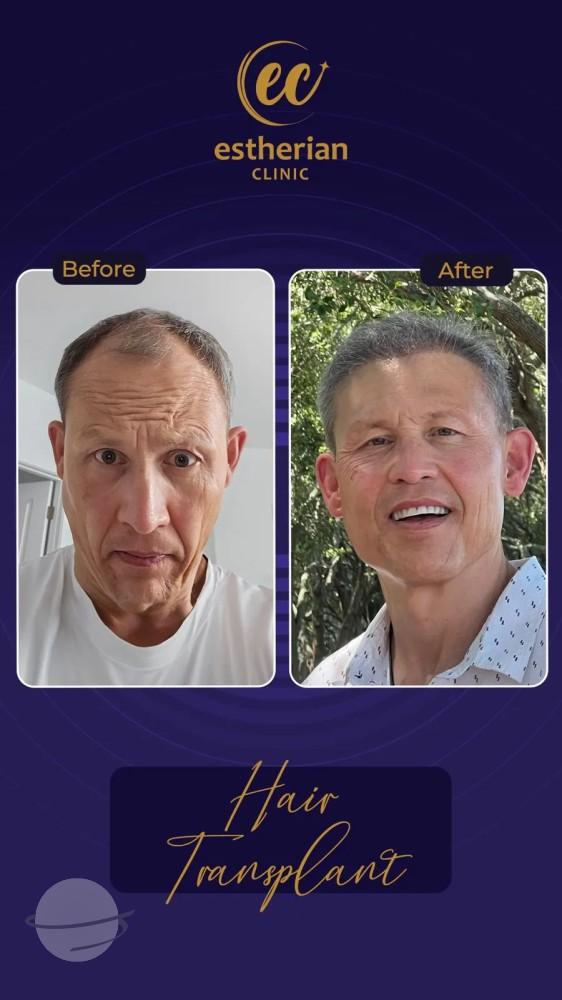 Cosmetic surgery Istanbul Before and after 5