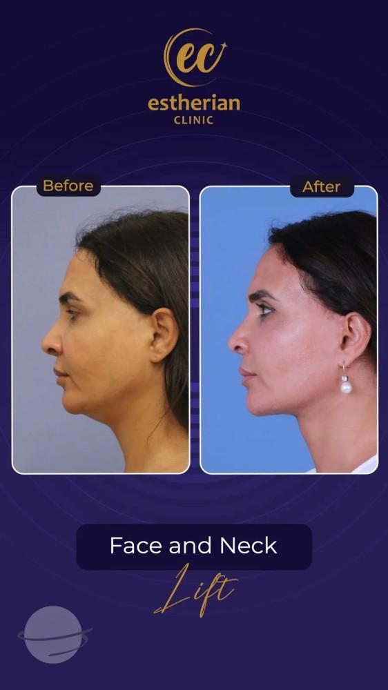 Cosmetic surgery Istanbul Before and after 11