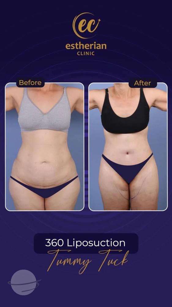 Cosmetic surgery Istanbul Before and after 17