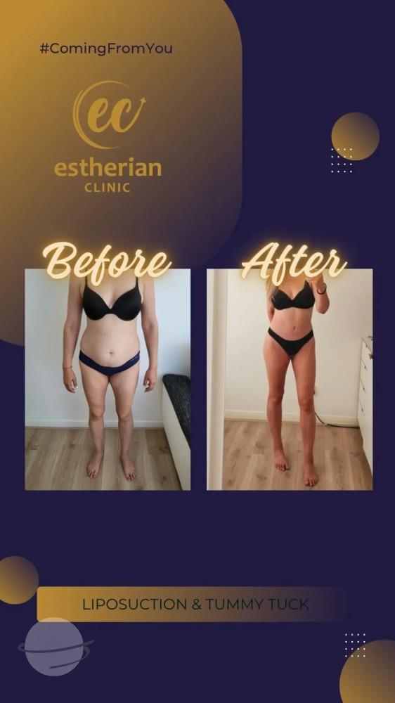 Cosmetic surgery Istanbul Before and after 18