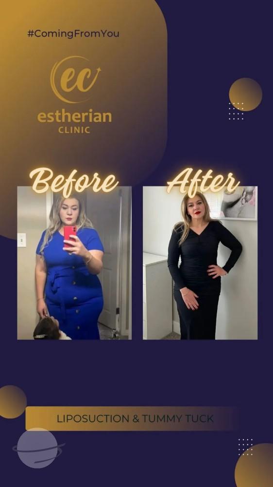 Cosmetic surgery Istanbul Before and after 19