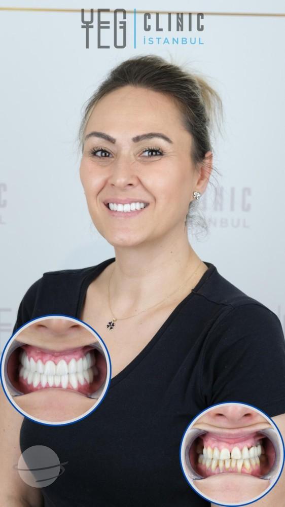 Yeg Clinic Istanbul Crowns X 20