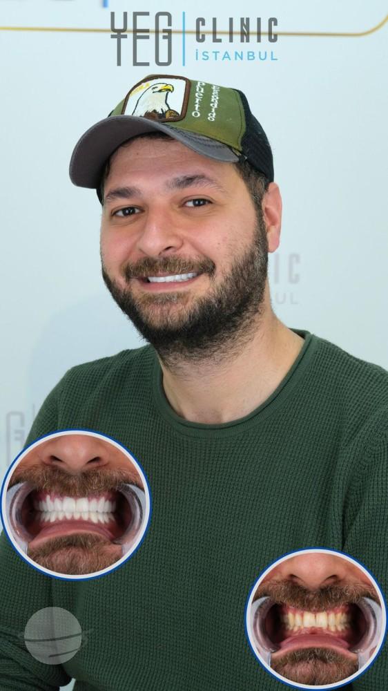 Yeg Clinic Istanbul Crowns X 20