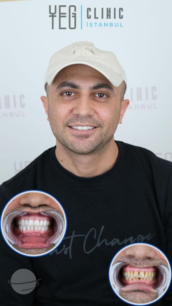 Yeg Clinic Istanbul Crowns X 20