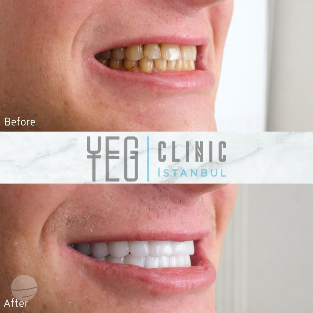 Emax Veneers