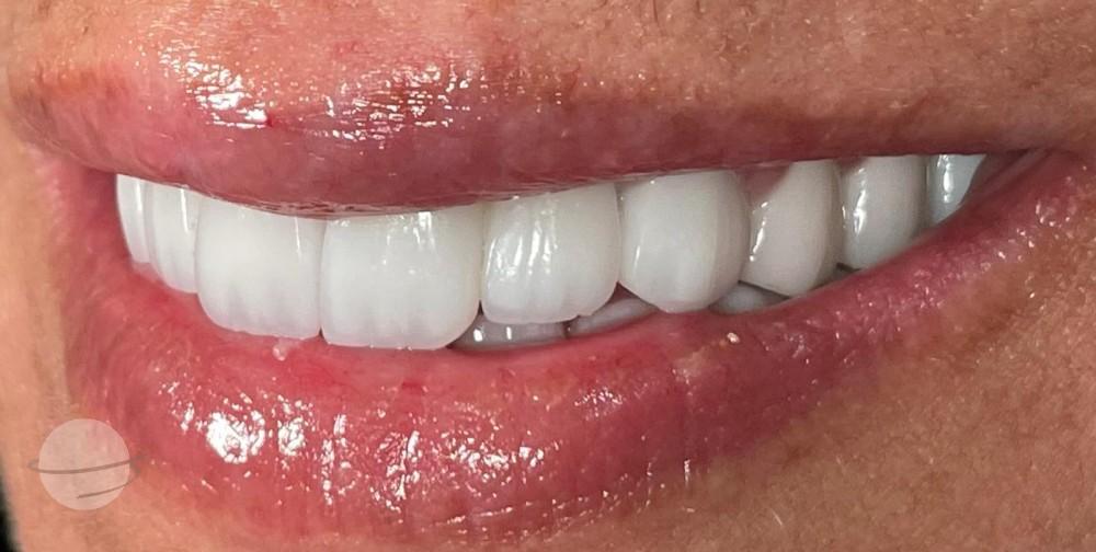 Dental Veneers