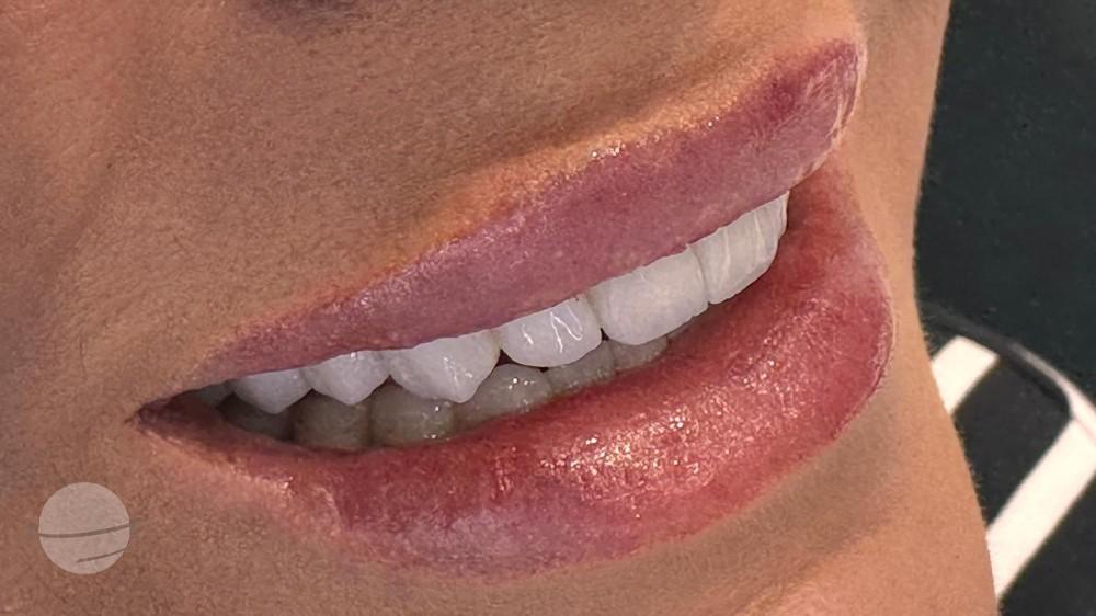 Emax Veneers