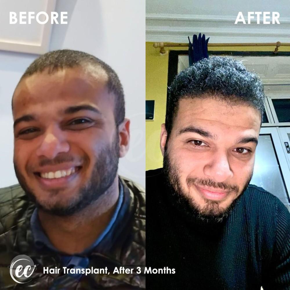 estherian Hair Surgery 7