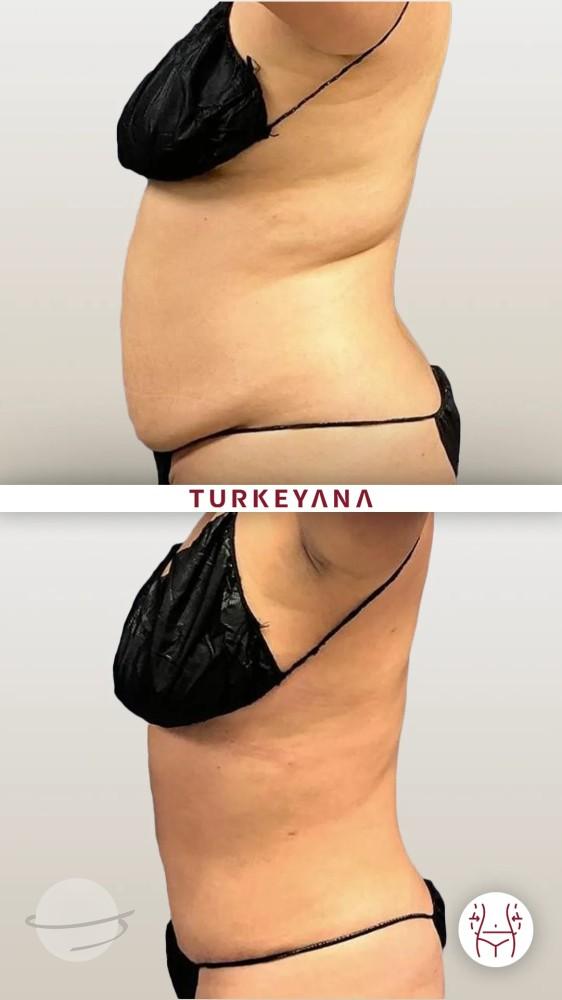 Résultat avant / après pour Liposuccion — Turkeyana