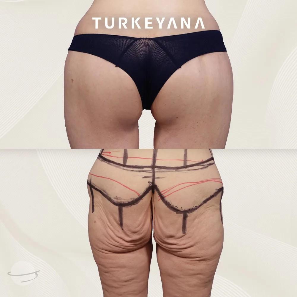 Résultat avant / après pour BBL Lipofilling fessier — Turkeyana