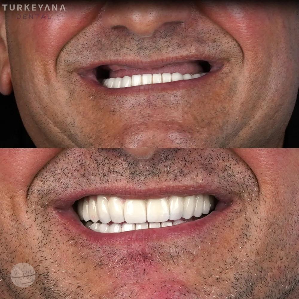 Résultat avant / après pour Implants Dentaires — Turkeyana