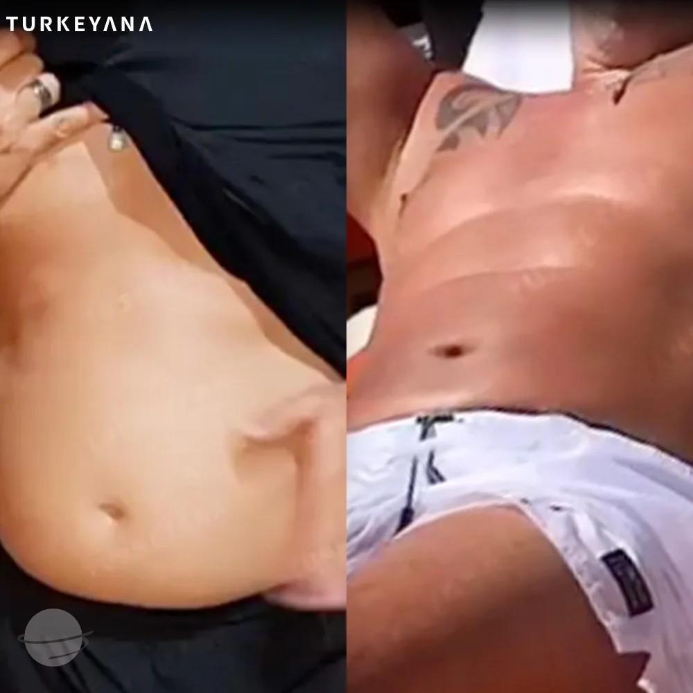 Résultat avant / après pour Hi-Def Lipo — Turkeyana