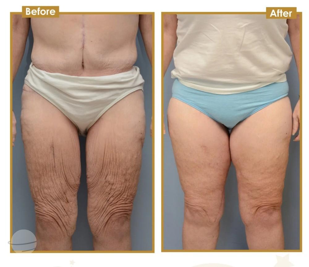 Résultat avant / après pour Lifting des cuisses — Estherian clinic