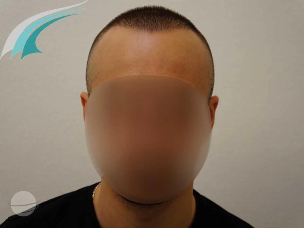 Résultat avant / après pour FUE by Doctor — Dr Beyhan Zeybek MD