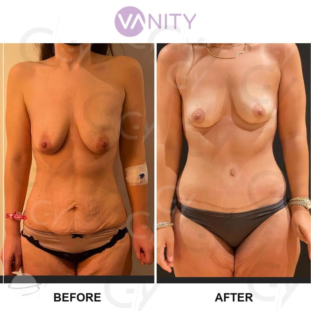 Résultat avant / après pour Abdominoplastie — Vanity Cosmetic Surgery Hospital