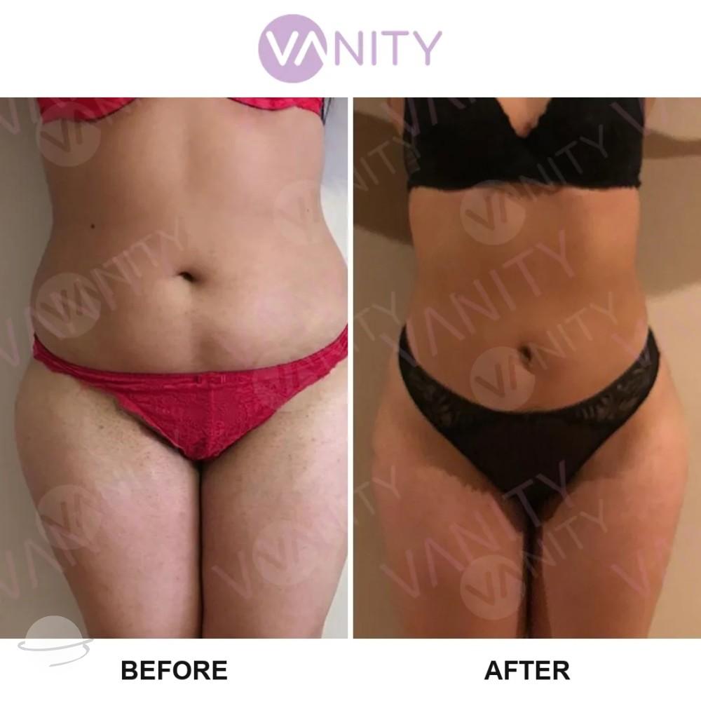 Résultat avant / après pour Liposuccion — Vanity Cosmetic Surgery Hospital