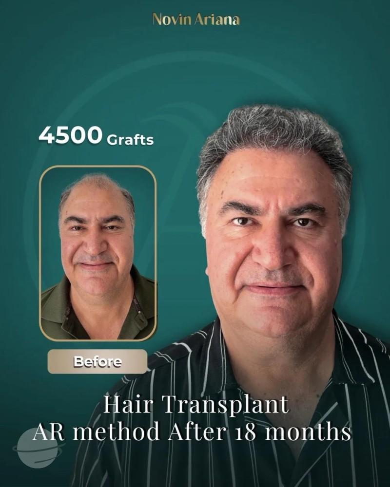 Résultat avant / après pour FUE — Novin Ariana BHT Hospital