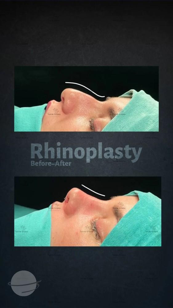 Résultat avant / après pour Rhinoplastie — Novin Ariana BHT Hospital