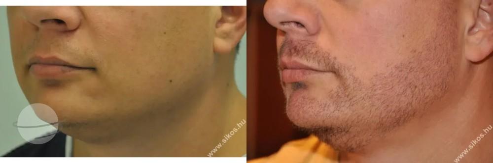 Greffe de barbe