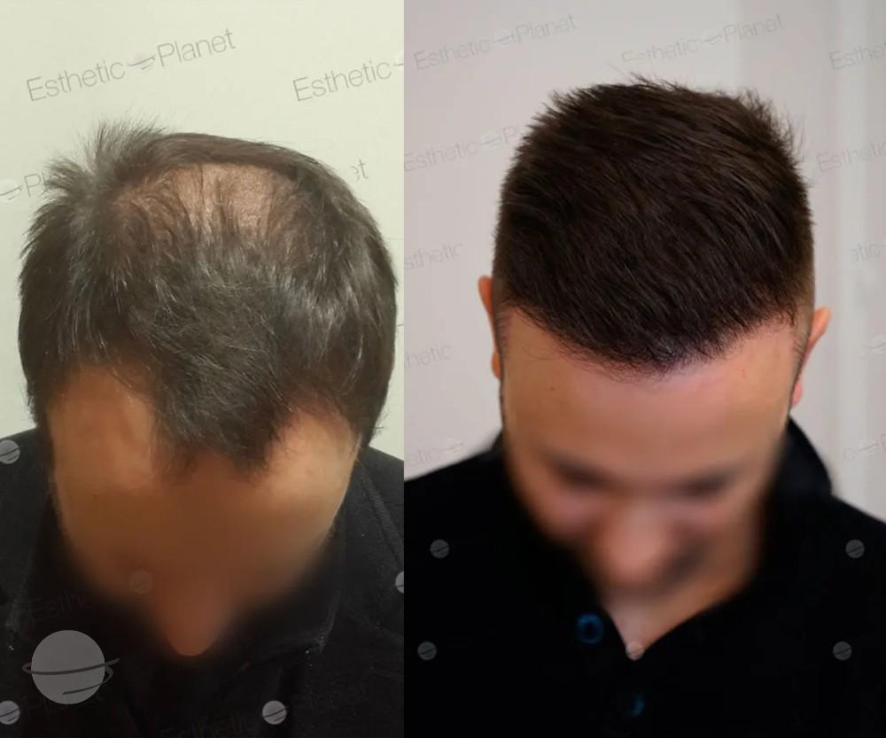 Avant Après 3800 FUE DR BEYHAN TOP VIEW