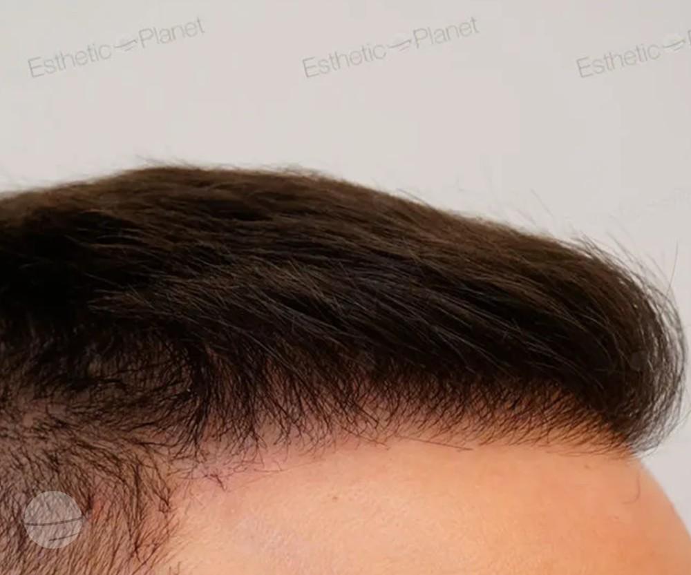 3800 FUE DR BEYHAN HAIRLINE CLOSEUP