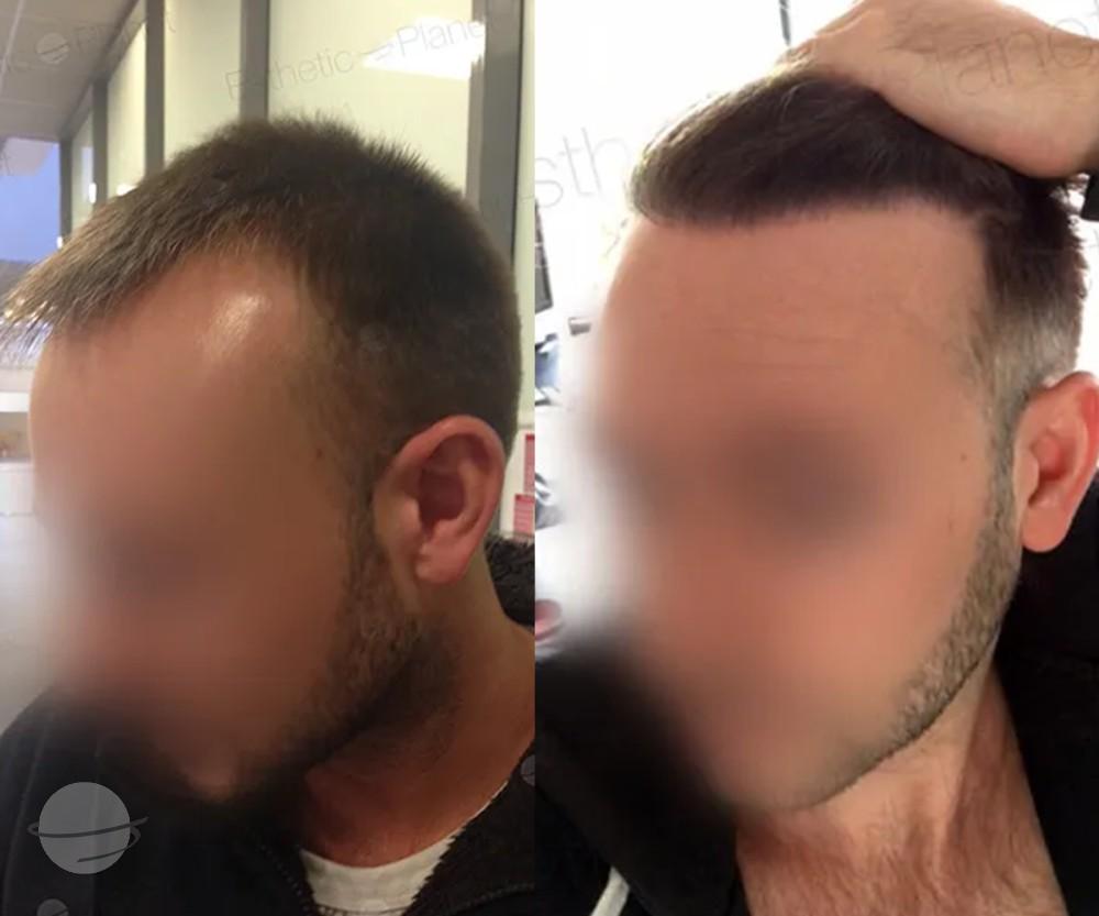 3000 FUE DR BEYHAN side VIEW_