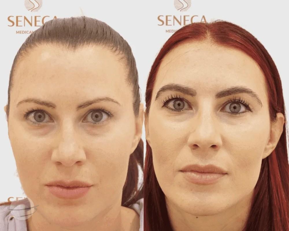 Greffe de Sourcils