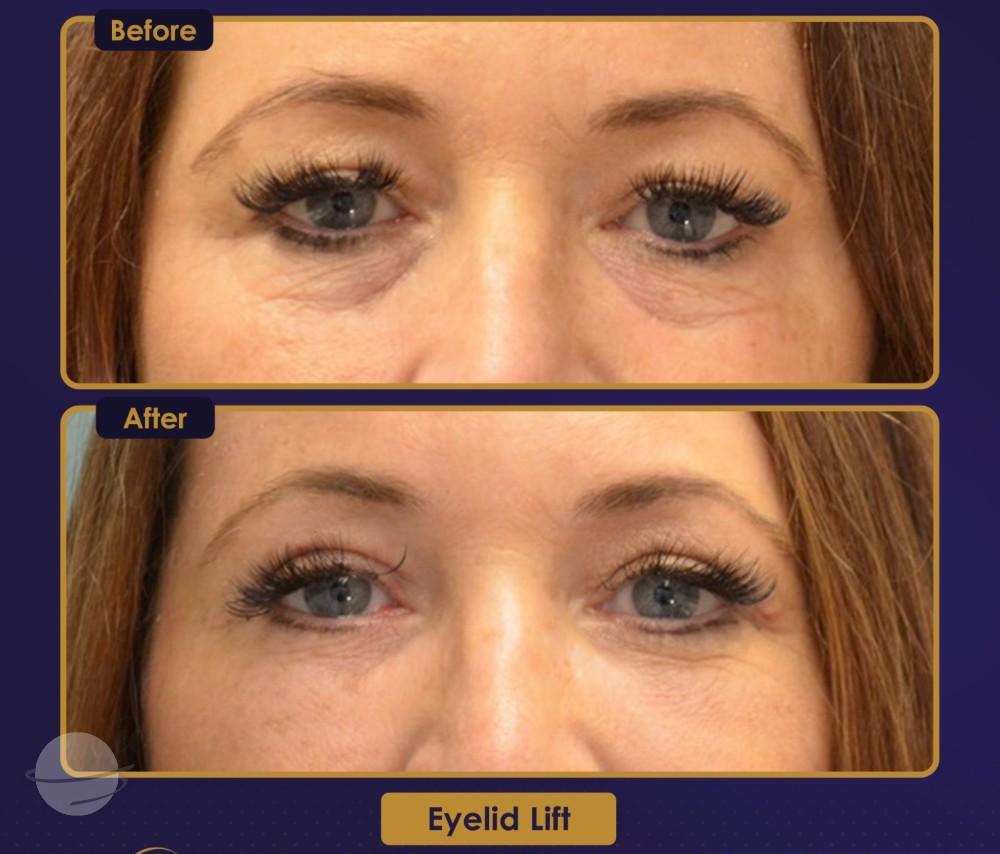 Résultat Estherian11