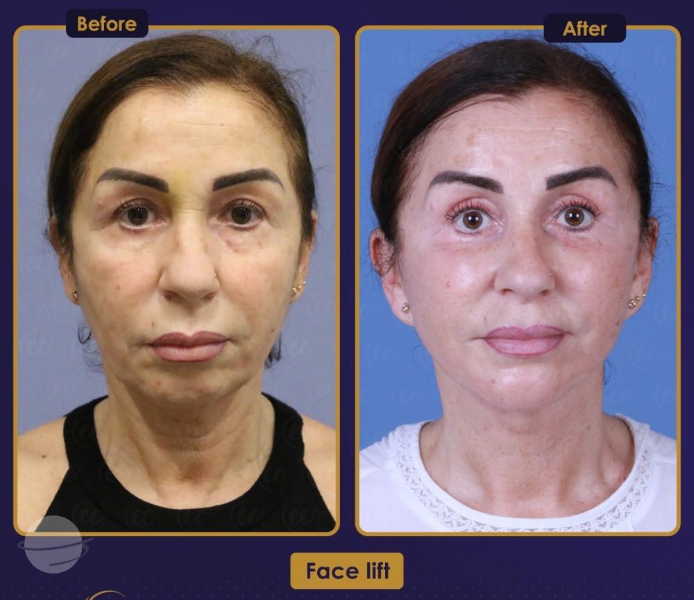 Résultat Estherian6