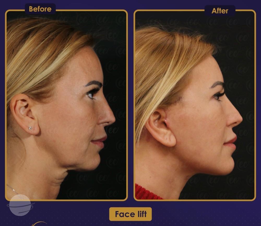 Résultat Estherian4