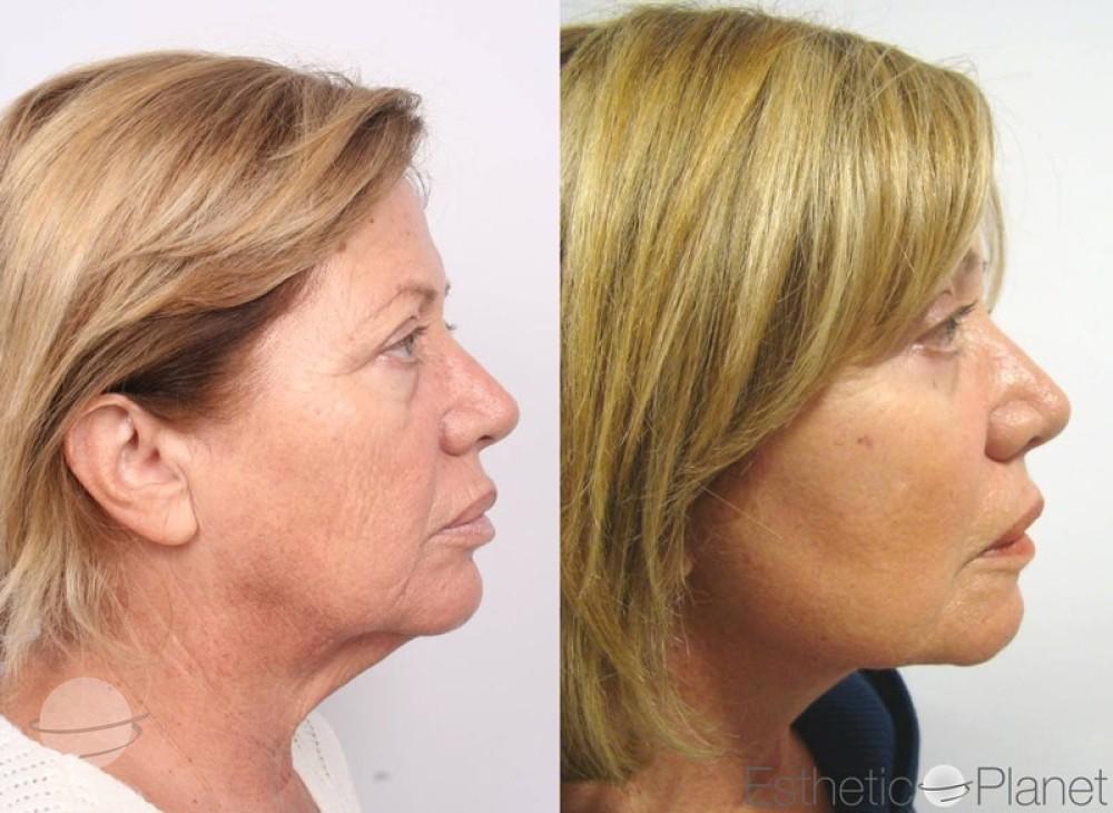 Blepharoplasty plastie - by Dr Ergin Er