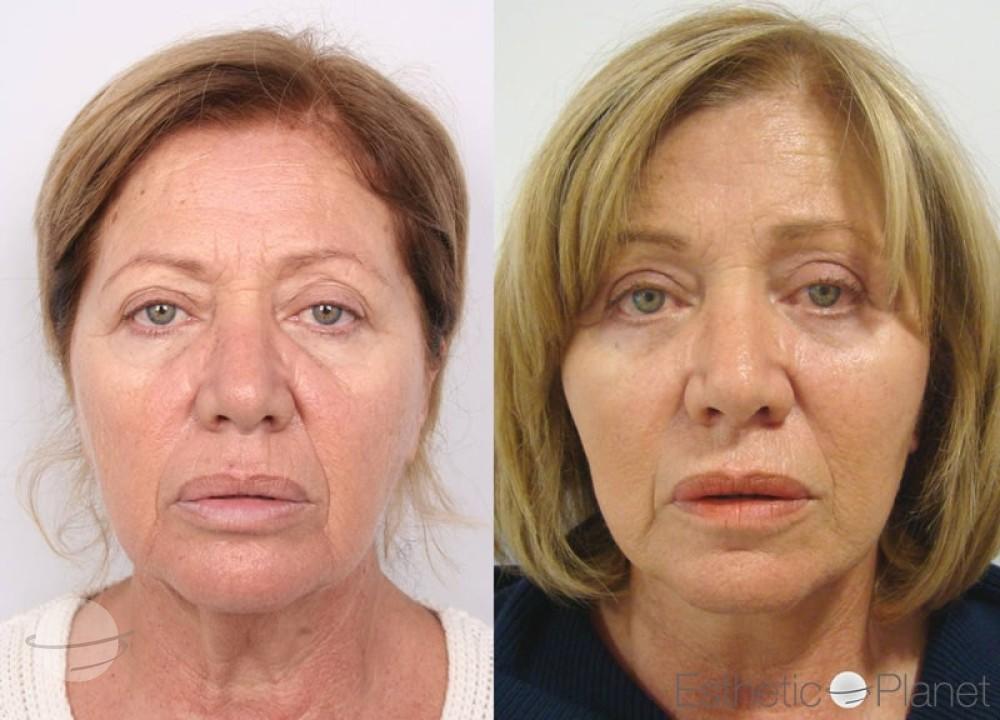 Blepharoplasty plastie - by Dr Ergin Er