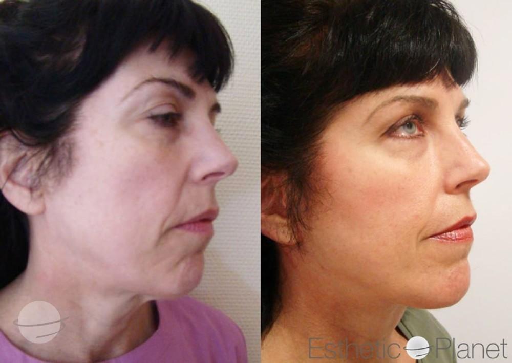 Blepharoplasty plastie - by Dr Ergin Er