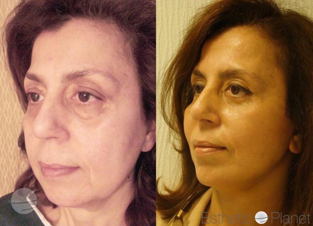 Blepharoplasty plastie - by Dr Ergin Er