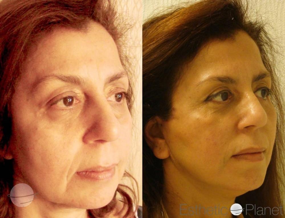 Blepharoplasty plastie - by Dr Ergin Er