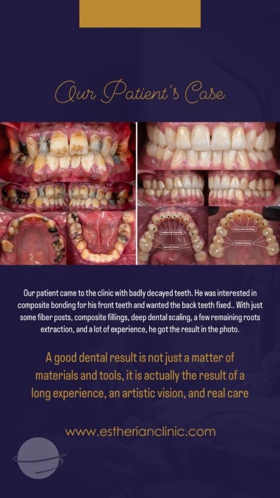 Estherian facette pelliculaires1