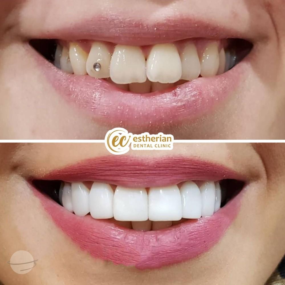 Estherian facette pelliculaires4