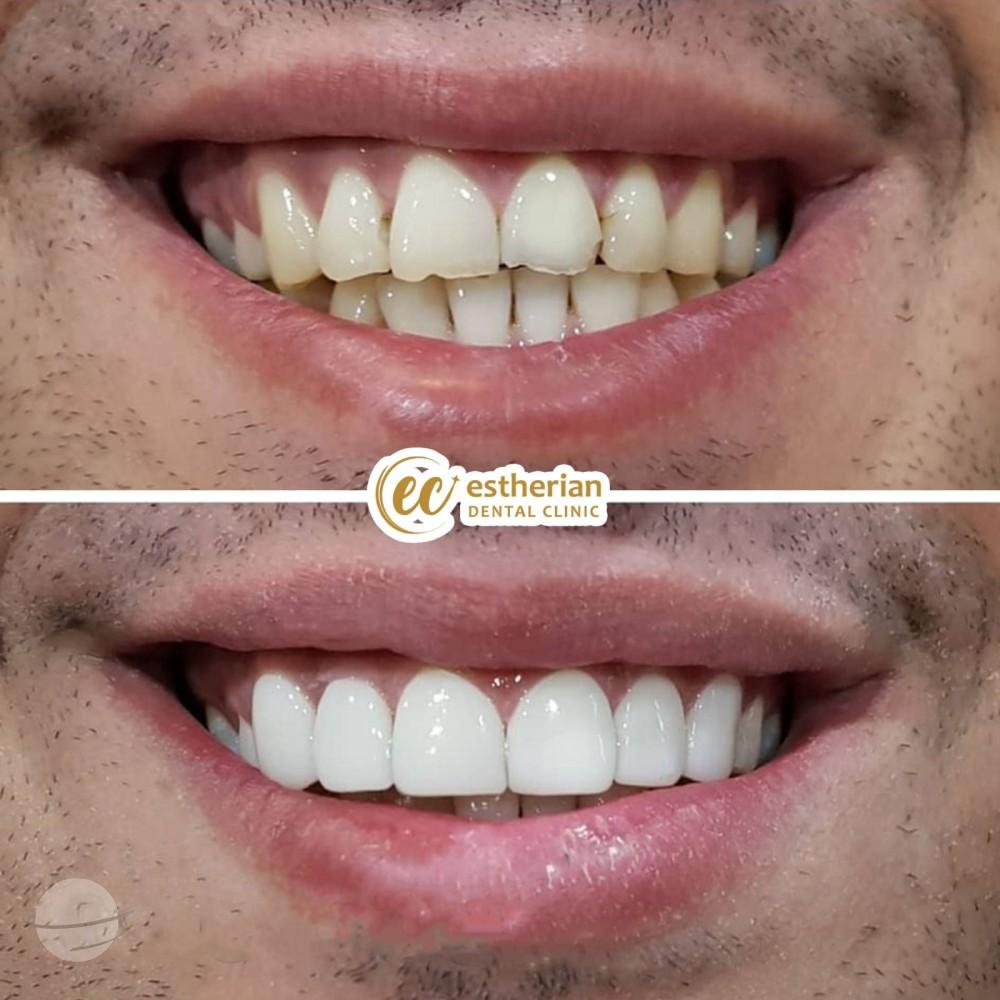 Estherian facette pelliculaires5