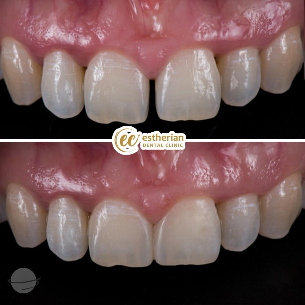 Estherian facette pelliculaires6