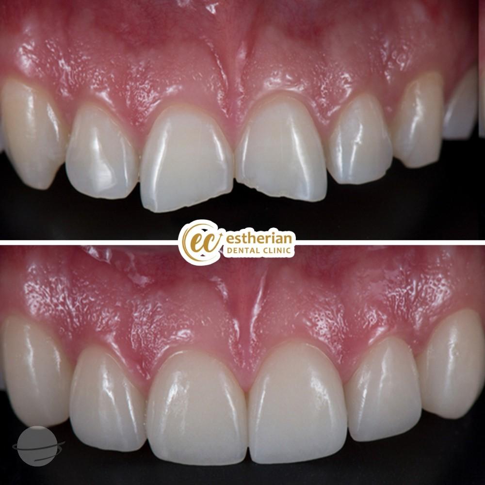 Estherian facette pelliculaires3