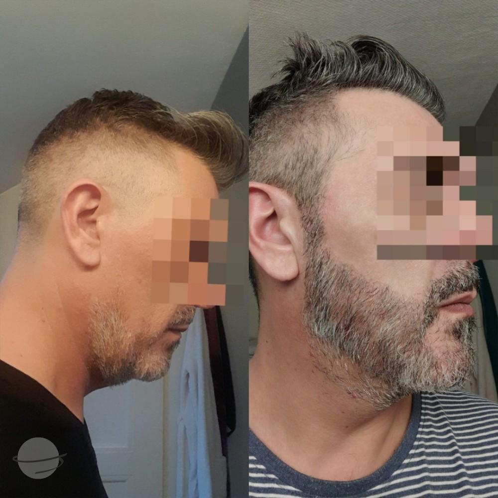 Beard Transplant by Esthetic Planet Team