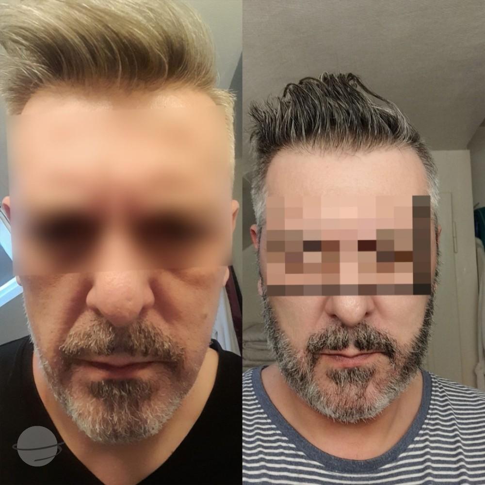 Beard Transplant by Esthetic Planet Team
